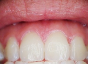 歯–夢の意味と解釈 