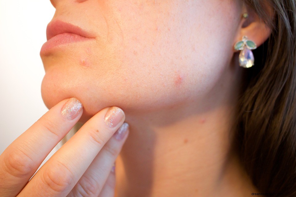 O que significa sonhar com acne? 