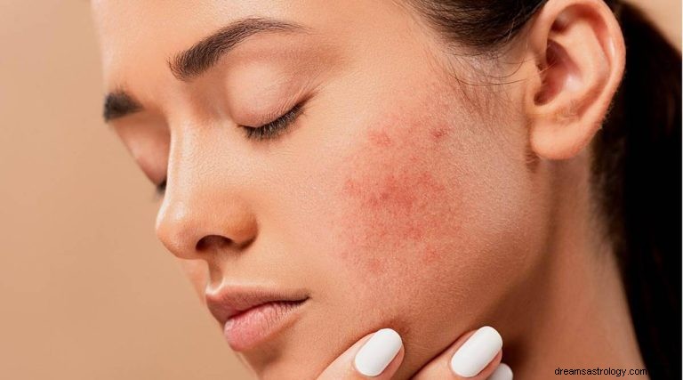 O que significa sonhar com acne? 