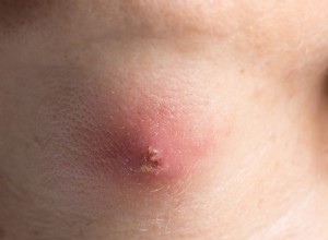 Vad betyder det att drömma om abscess? 