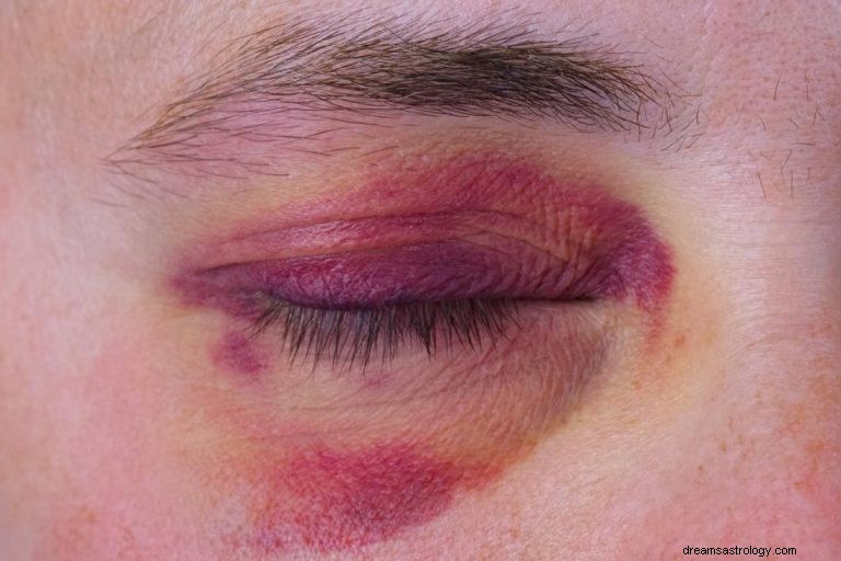 Wat betekent het om te dromen over Black Eye? 