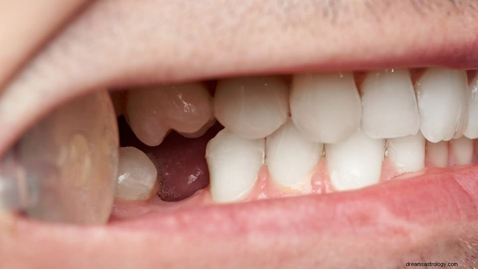 Acordou com um sonho de dentes caindo? [Conheça 37 tipos com significados] 