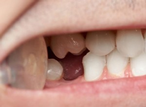 Vous vous êtes réveillé avec un rêve de chute de dents ? [Connaître 37 types de cela avec des significations] 