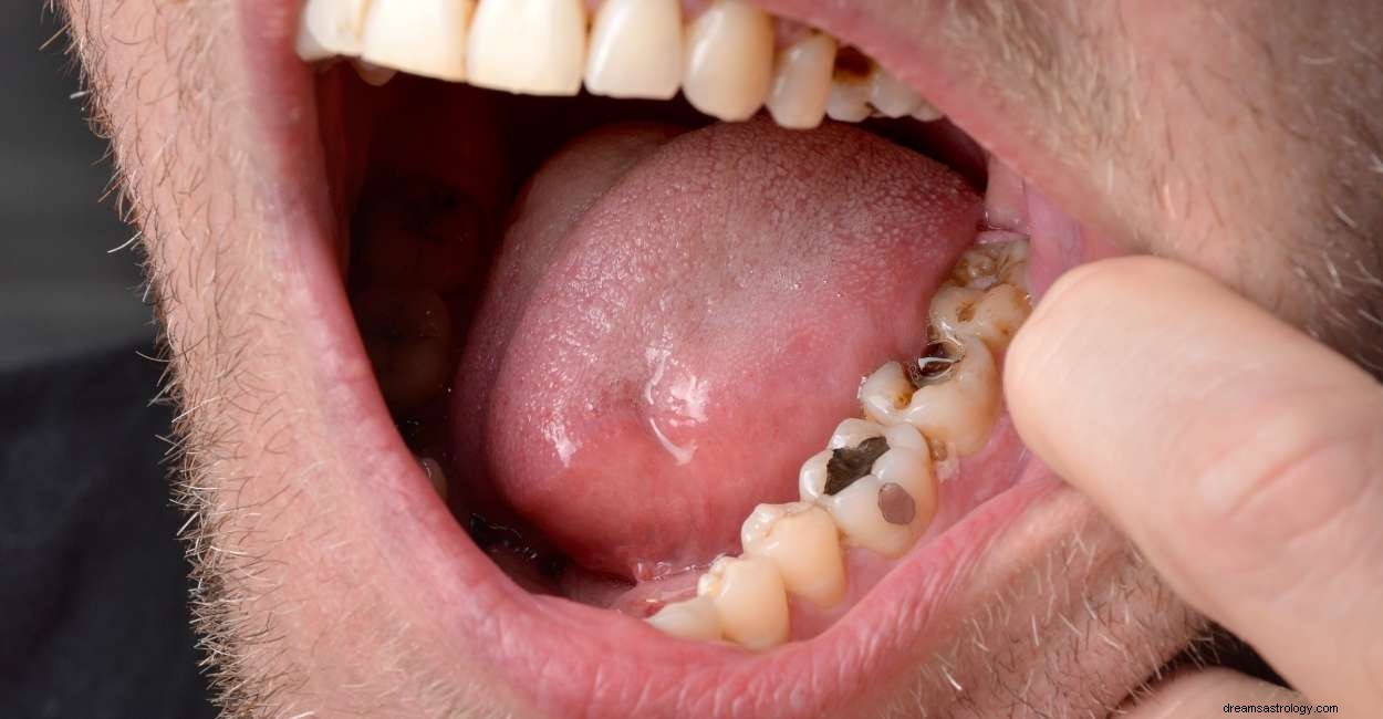 Você acordou com um sonho de dentes podres? Aqui está o que significa 