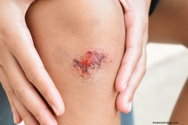 Blessure – Signification et symbolisme des rêves