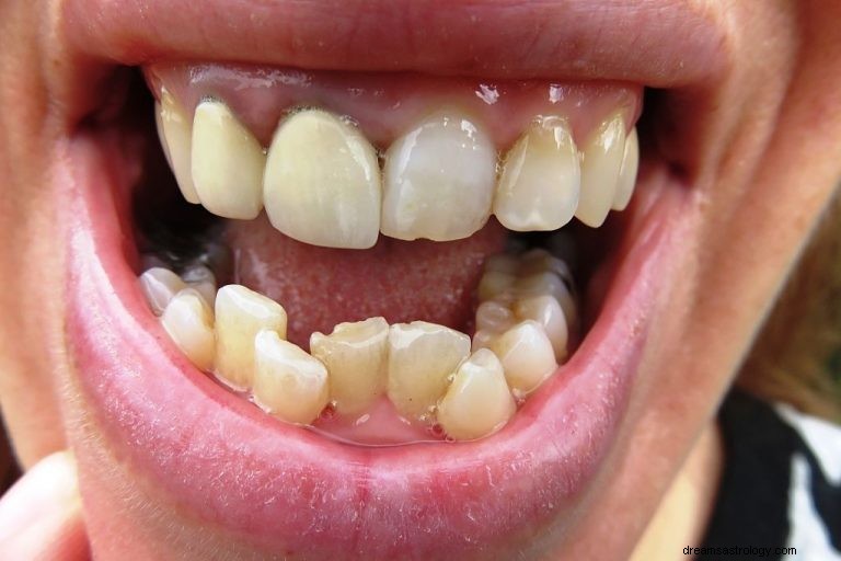 Schiefe Zähne – Bedeutung und Symbolik von Träumen